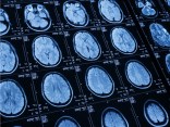 Falling Correctly, Proper Therapy Can Minimize Concussion Affect