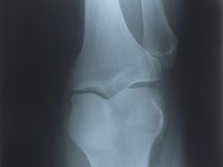 Orthopedic in Knee Deep for Fixing Wrong Leg