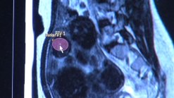 Surgery Without an Incision? It's Being Done.