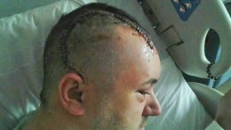 Man Left in Coma After Bat Attack