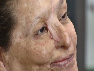 Acid Attack Victim: Emotionally I'm Fine, But Still Hurt