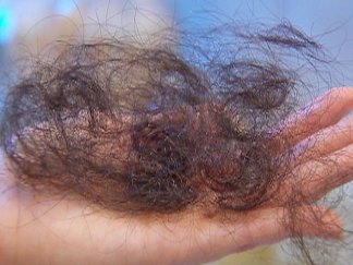 Hair Loss, Irritation Blamed on Popular Hair Product