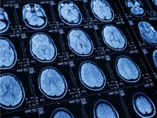 Falling Correctly, Proper Therapy Can Minimize Concussion Affect