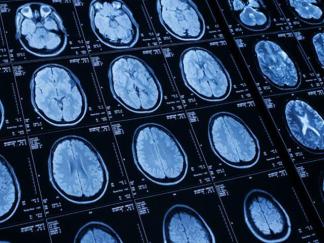 Protecting theTeenage Athlete's Brain