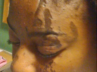 Children Burned With Caustic Substance