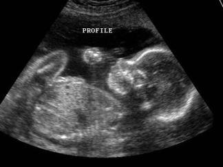 Hidden Cameras Found  in Ultrasound Office
