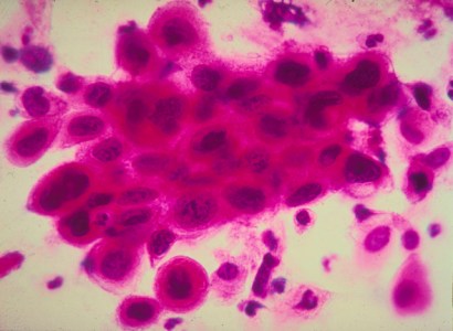 Close up of cancer cells.