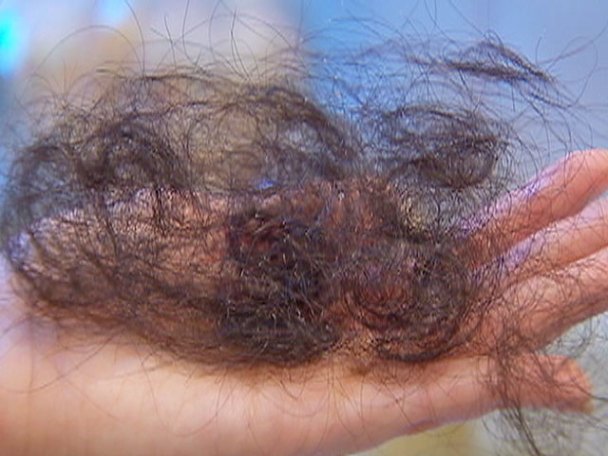 Hair Loss, Irritation Blamed on Popular Hair Product