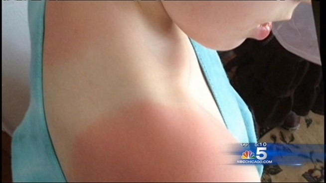 A mother in Washington posted photos of her severely sunburned children who were not allowed to put sunscreen on during a field trip. Jessie Mitchener s daughters Violet and Zoey went to the hospital after getting burnt on the field trip, since the school has a policy that prevented the teacher from helping them with the sunscreen. The Illinois School District is saying schools here can decide on their own policies. Sharon Wright reports.
