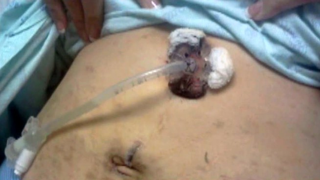 A North Texas woman says airport security agents strip-searched her and then swabbed her medically implanted tube for explosives.