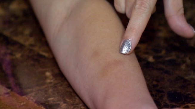 Girl, 10, has a bruise on her arm a day after she said she was singled out by the teacher as students were heading inside from recess.