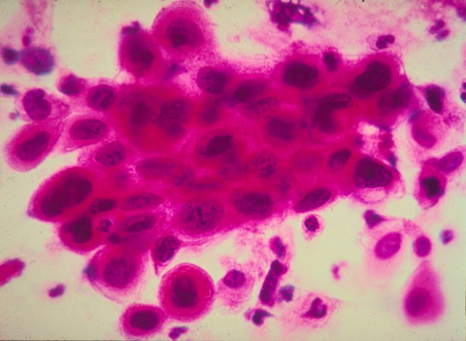 Genetic Test for Colon Cancer