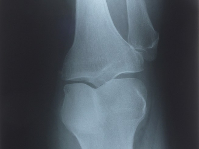 Orthopedic in Knee Deep for Fixing Wrong Leg