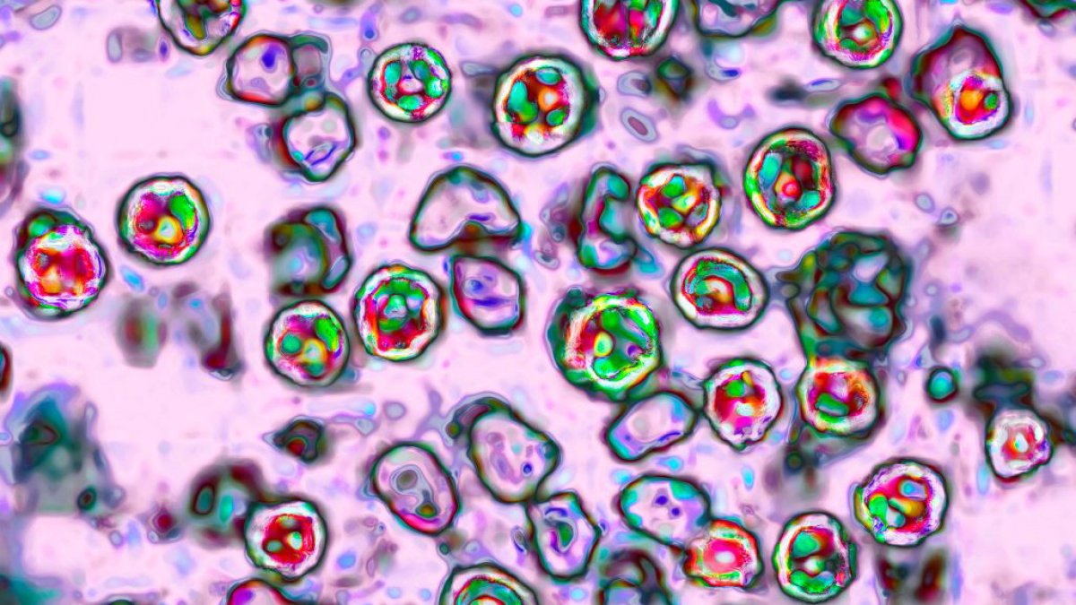 ny measles outbreak