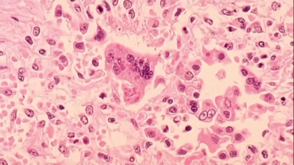 NBC Chicago reports a confirmed case of measles in a DuPage County resident according to health officials