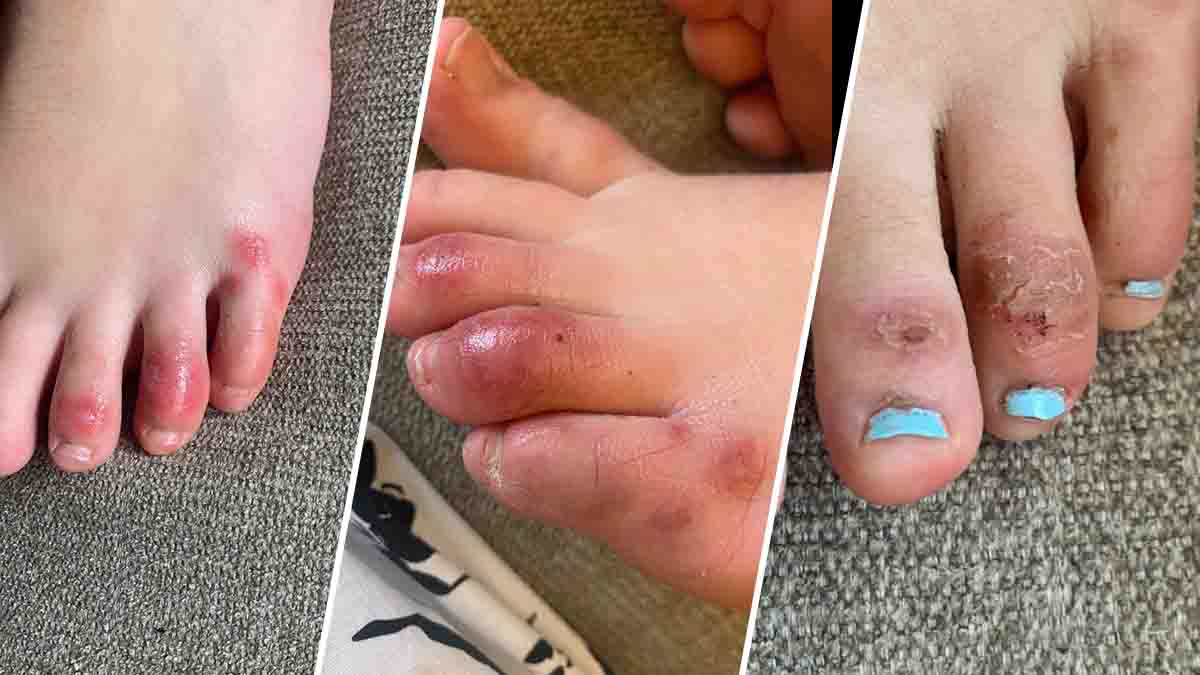 COVID Toes': Mysterious Skin Condition 