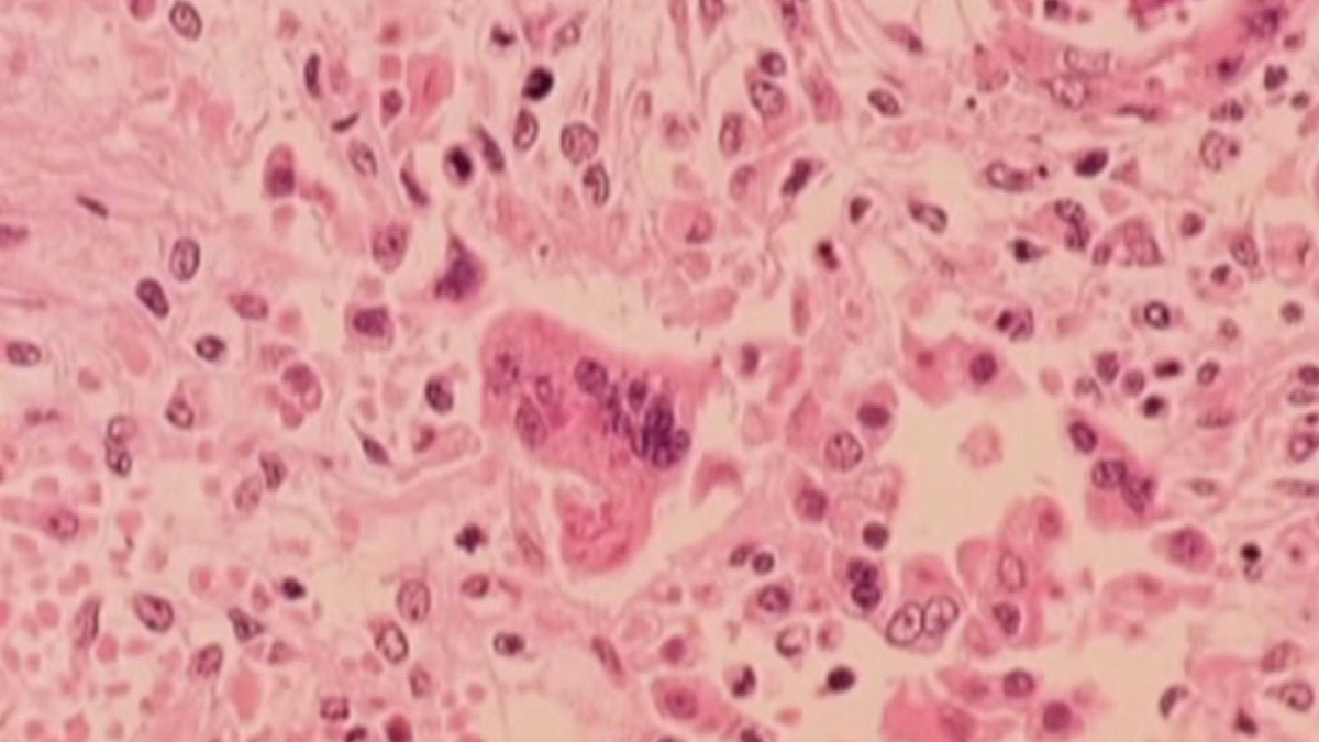 Public health officials confirm measles exposure late last month at suburban Walmart