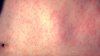 What does a measles rash look like? What to know after  new Chicago-area measles cases, including 1 at O'Hare