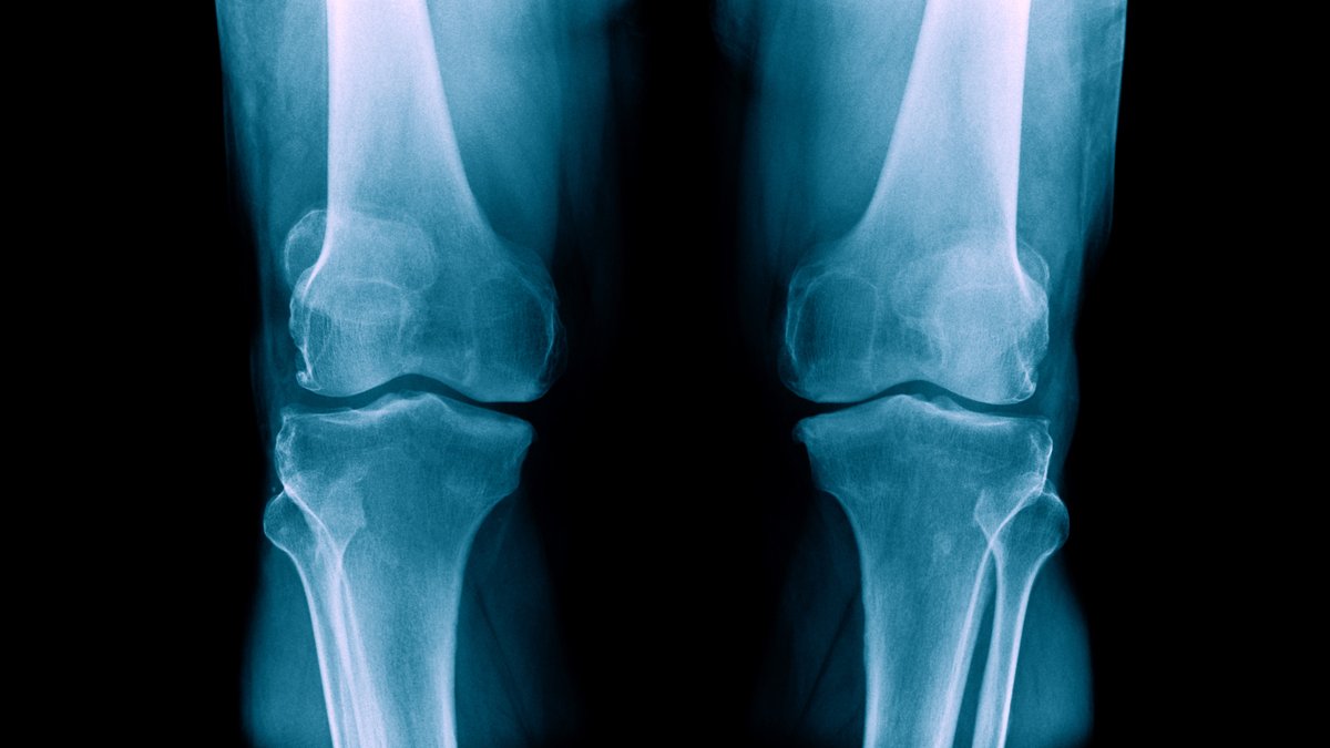 Doctor hopes a simple scan will can help more women avoid osteoporosis fractures