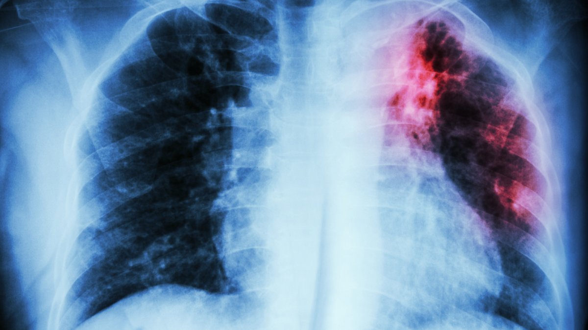 Kansas sees ‘largest tuberculosis outbreak in US history, nearly 70 cases reported