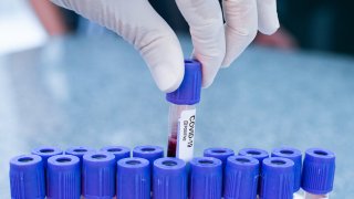 Hands of a laboratory worker holding positive test tube for COVID-19 coronavirus