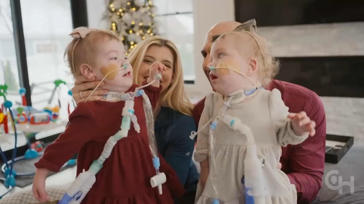 How are the Altobelli conjoined twins doing today? All the details