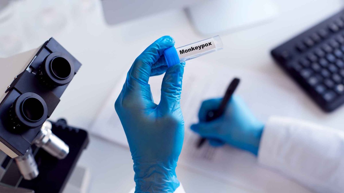 Premier cas possible de monkeypox signalé dans le comté de Suburban Cook – NBC Chicago
