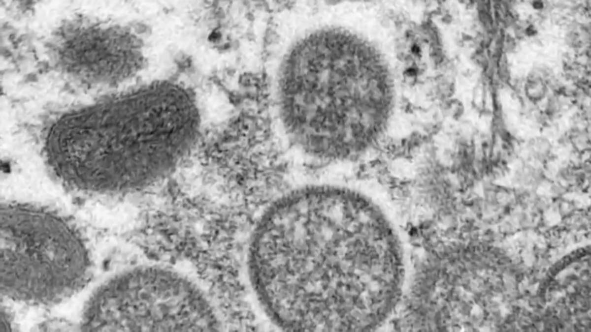 芝加哥报告 5 例新病例，建议在夏季聚会上预防猴痘 – NBC Chicago