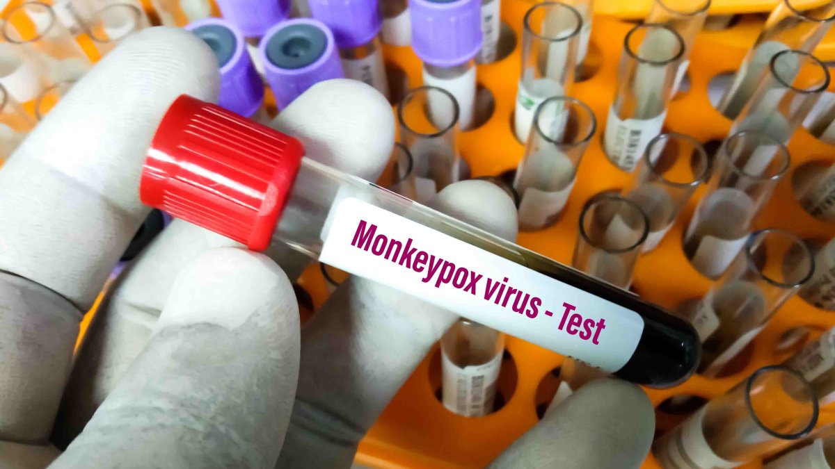 Suspected Monkeypox Cases Continue to Climb in Ill. With More Reported in Chicago - Vimarsana News