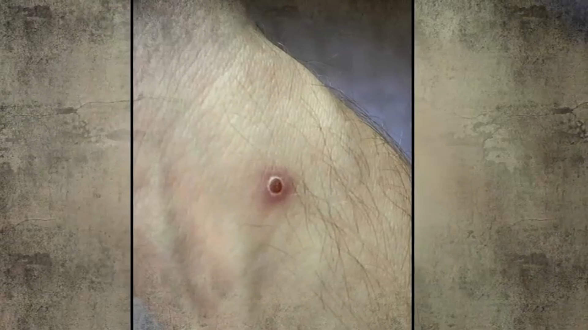 How is Monkeypox Contracted? Here's How the Virus Spreads and Where Risk is Highest - Vimarsana News