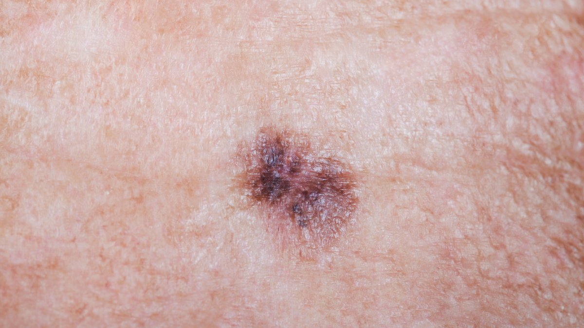 doctor-reports-skin-cancer-diagnoses-have-gone-up-significantly