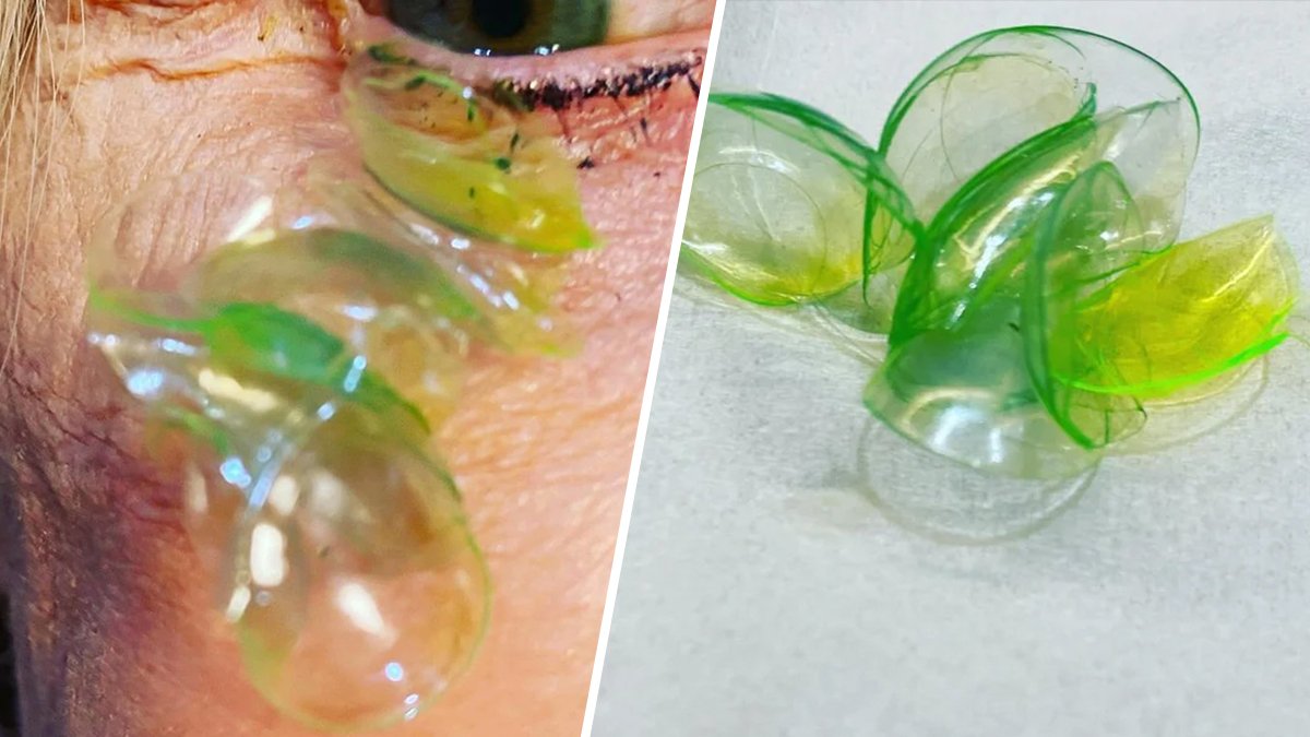 Woman Had 23 Contact Lenses Stuck Under Her Eyelid, Doctor Says – NBC Chicago - Vimarsana News