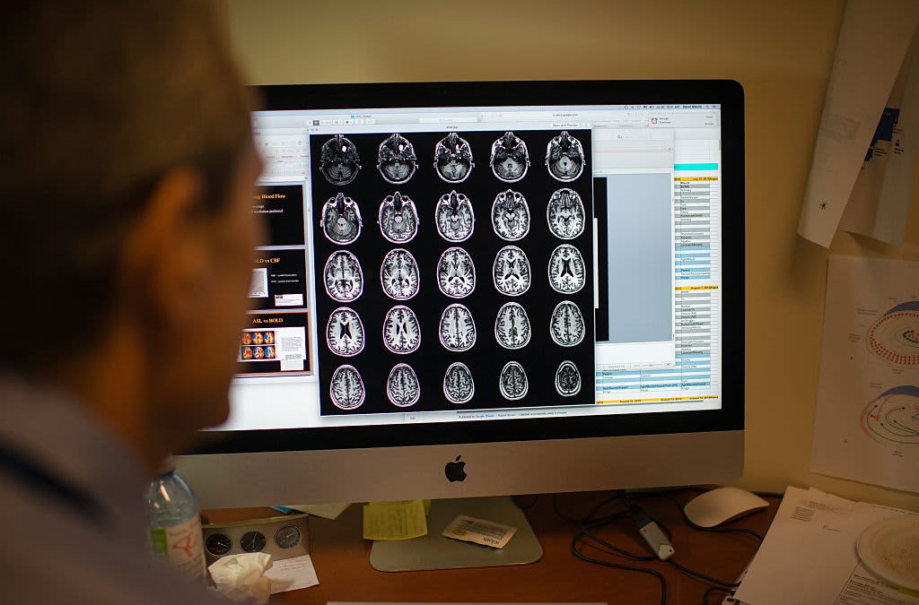Alzheimer's Drug Trial Shown to Slow Cognitive Decline in Long Fight Against Dementia