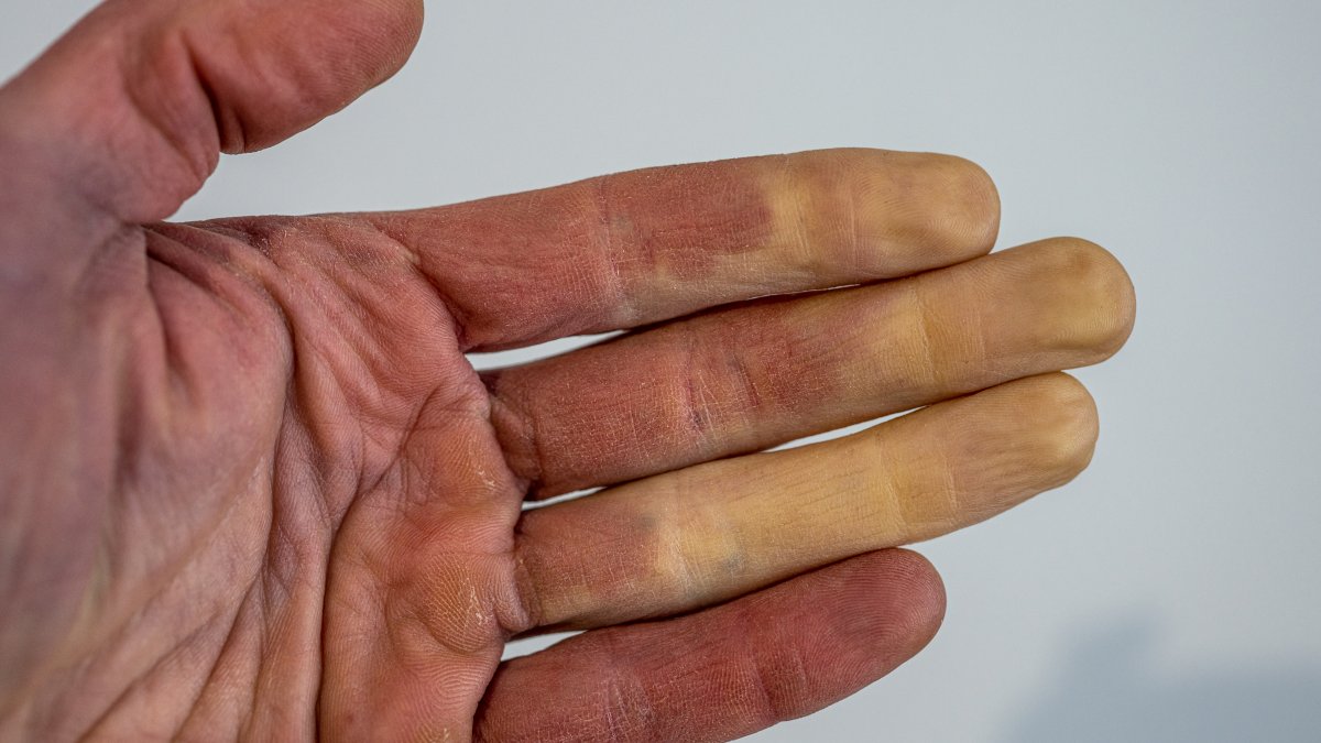 What Is Raynaud's Disease? Disorder Causes White or Blue Fingers, Toes