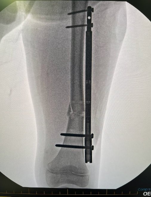 How Local Surgeons Extended an 11-Year-Old Boy’s Leg By More Than an ...