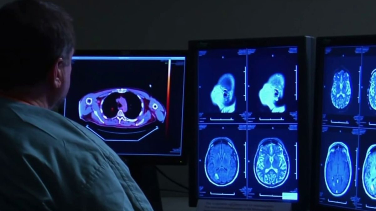 Husband recognizes wife's stroke after seeing NBC Chicago story on symptoms - Vimarsana News