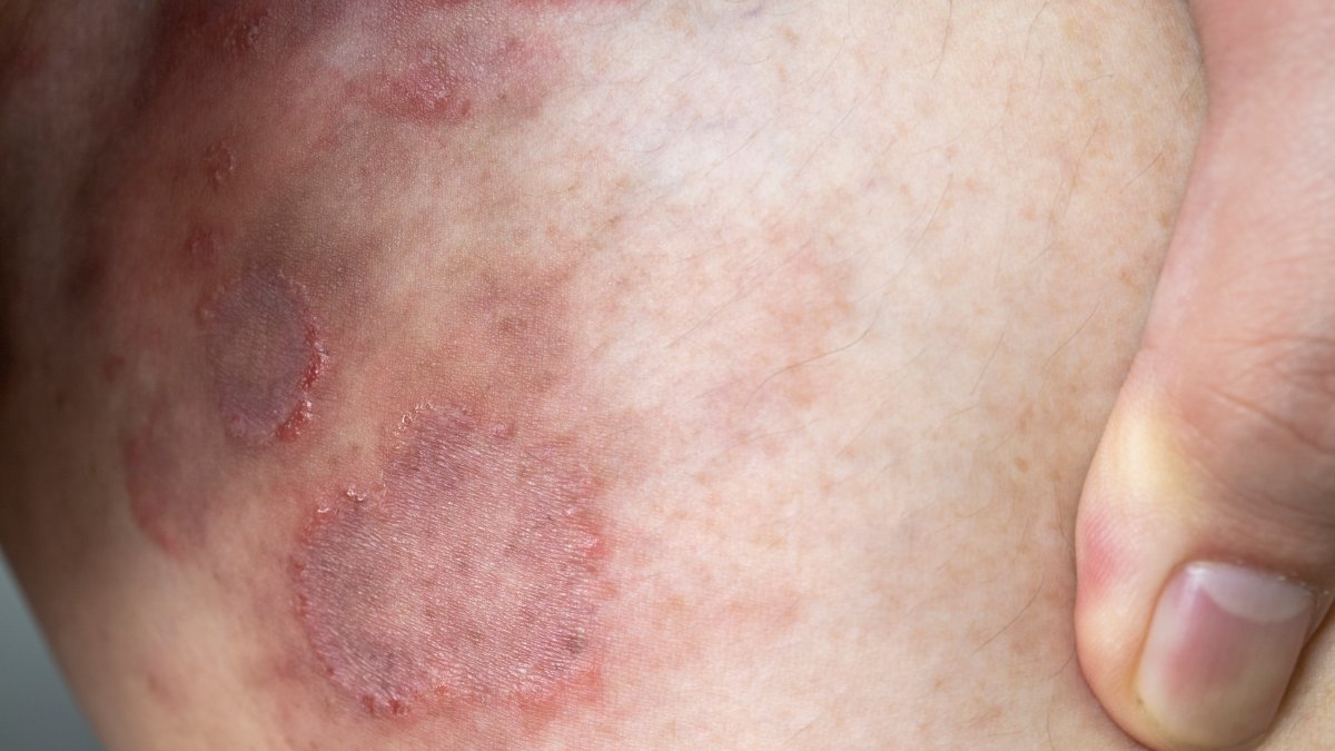 First Resistant Ringworm Infections Detected in United States – NBC Chicago - Vimarsana News