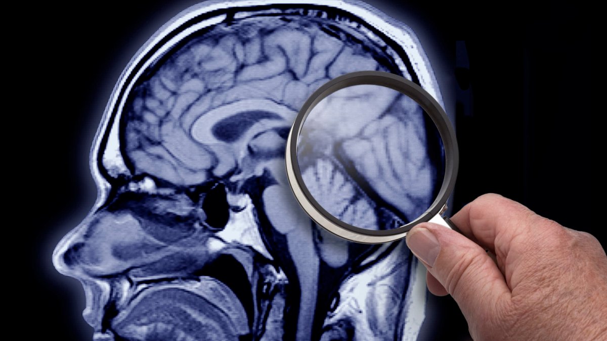 Health insurance companies may not cover new Alzheimer's drug Leqembi – NBC Chicago - Vimarsana News