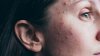 Summer skin care myths and tips, according to dermatologist Dr. Pimple Popper