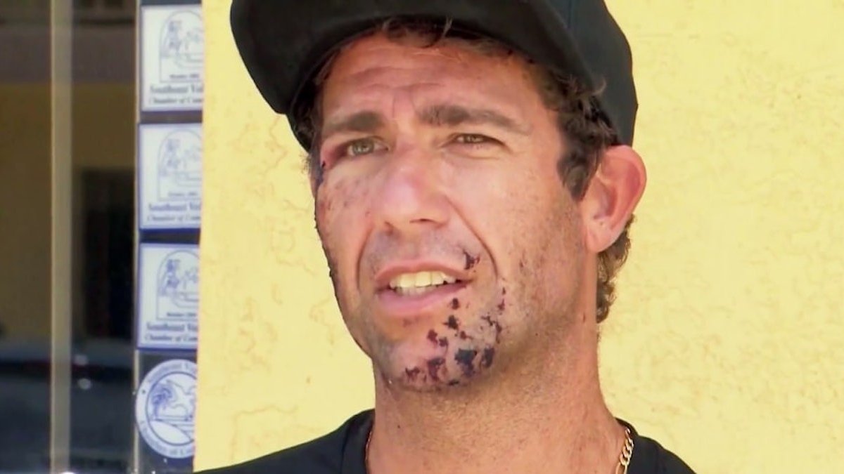 Surfer recalls getting bit in the face by shark at Florida beach – NBC Chicago - Vimarsana News