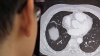 Woman's surprising cancer diagnosis an example of growing trend