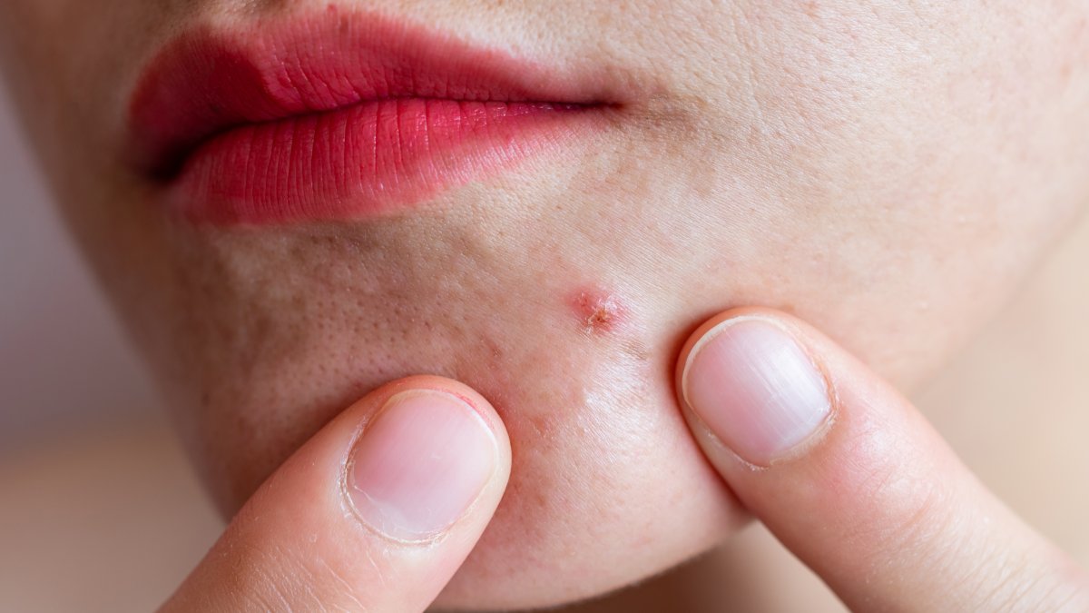 Acne vaccine? UC San Diego researchers say ‘promising’ vax may zap the ...