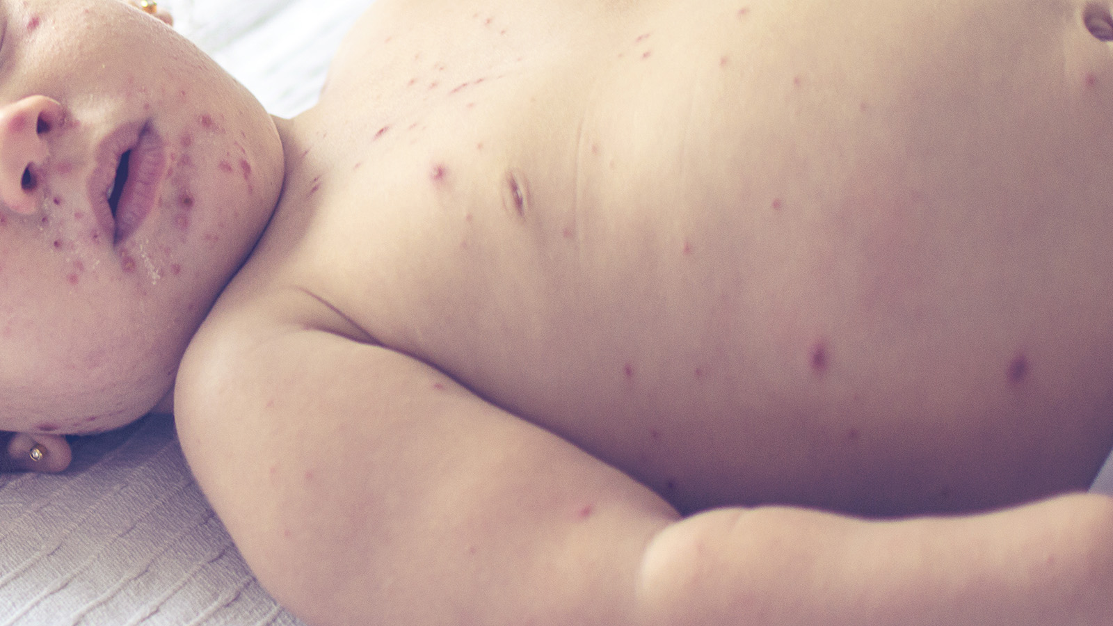 How effective are measles vaccines and do you need a booster? What to know