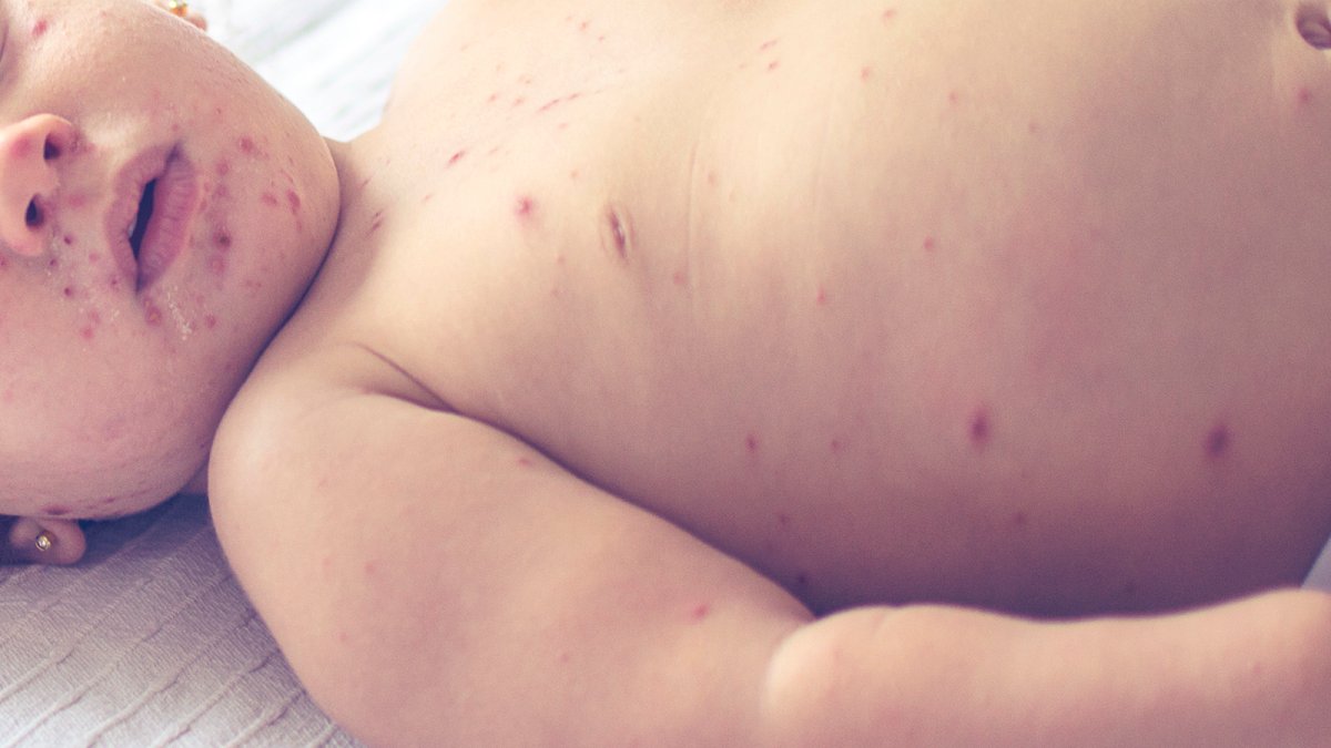 What it's like to get measles: Symptoms, severity and treatment – NBC Chicago - Vimarsana News