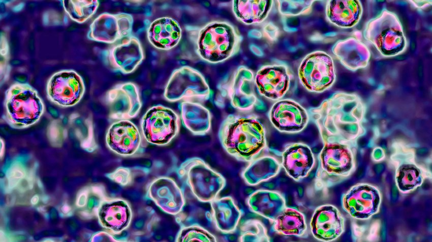 The measles virus, paramyxoviridae from the Morbillivirus family, transmission microscopy view. (Photo by: BSIP/Universal Images Group via Getty Images)