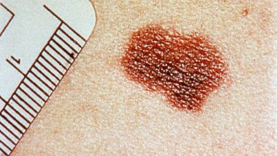 Melanoma Monday: Here's how to reduce your risk of skin cancer