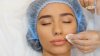 Avoiding complications with Botox injections: 3 things to look for