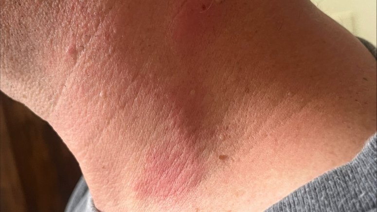 Straw Mites Rash Cicadas and mites? What to know about oak leaf itch mite – NBC Chicago
