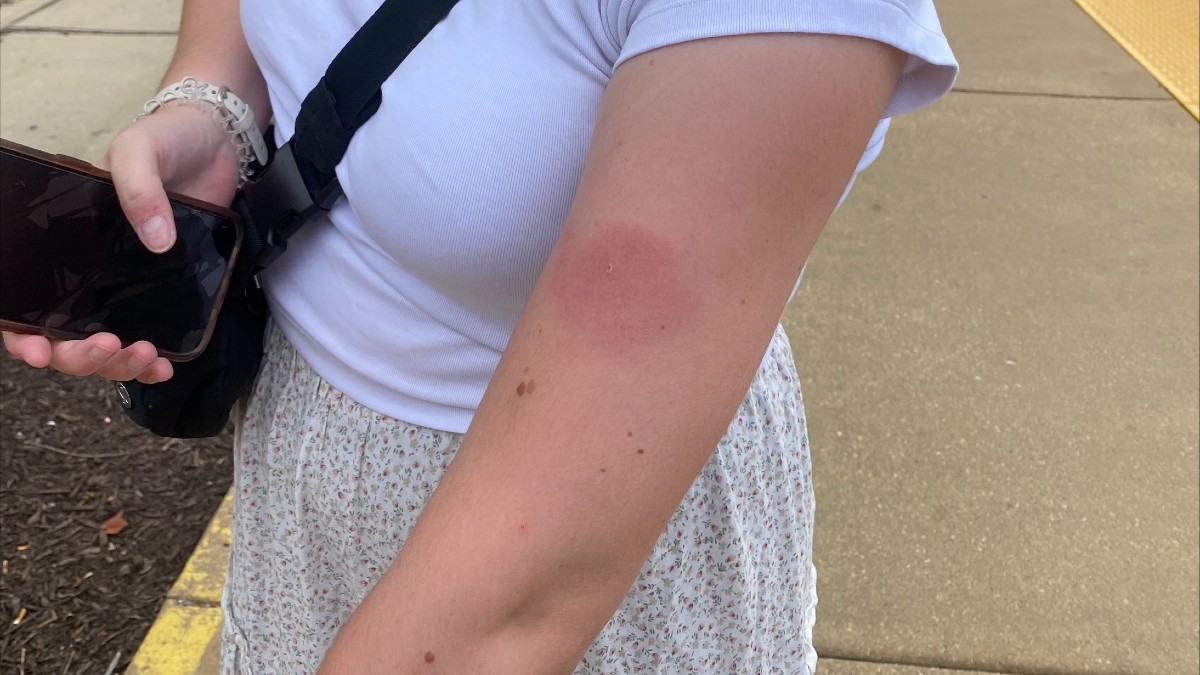 Bug bites in Chicago area could be from mites after cicada invasion
