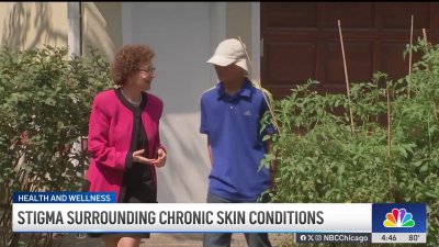 Mental Health Monday: Student speaks out about bullying over skin condition